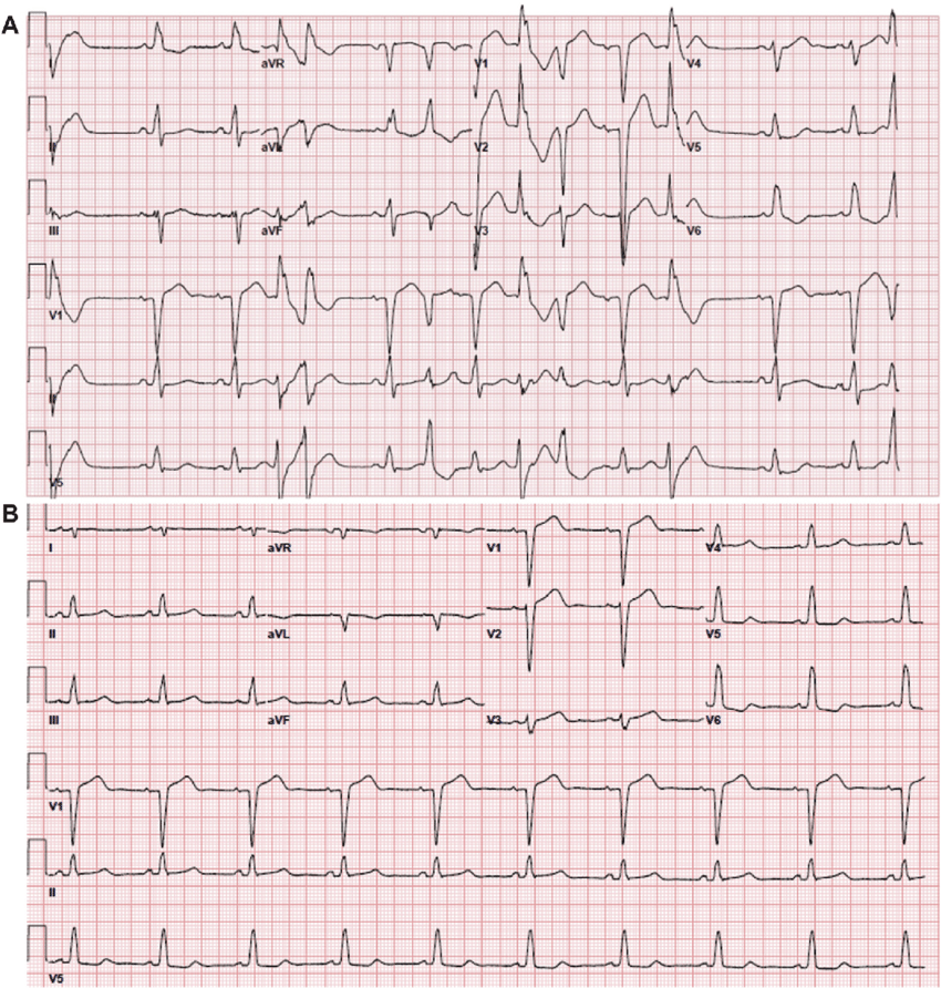 EKG